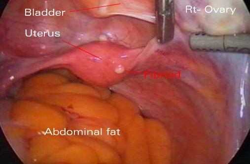 Pelvis showing uterine fibroid. Laparoscopic view of pelvis showing uterine 